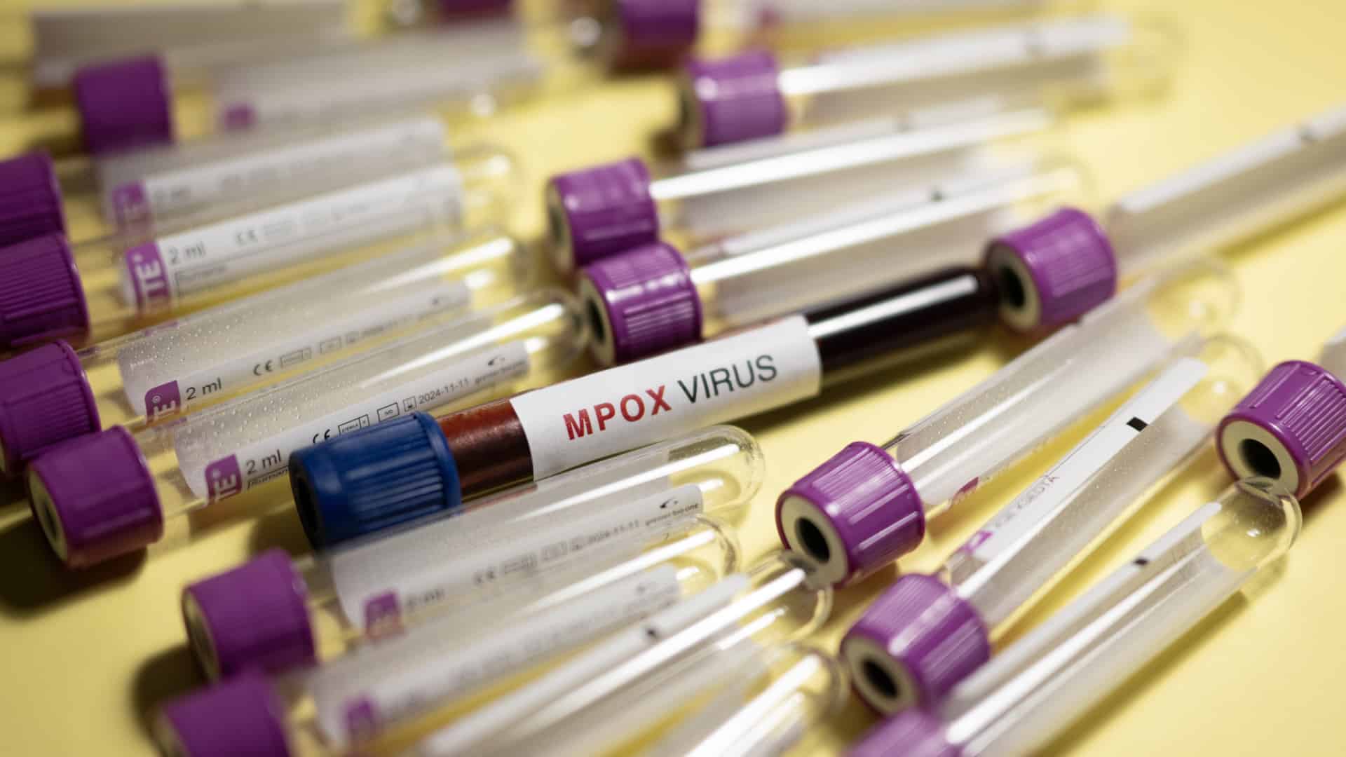 Les Açores détectent un cas d'infection par mpox chez un patient non résident.