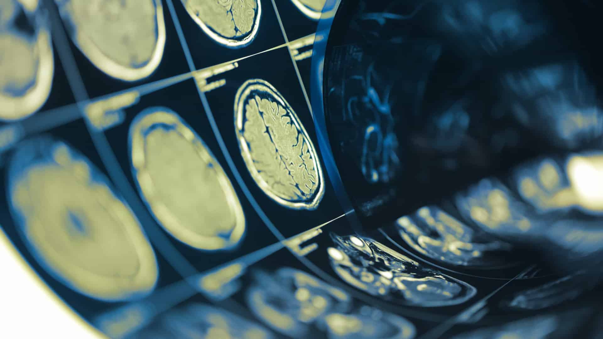 Journée du Cerveau. Les facteurs de risque (et signaux d'alerte) à connaître