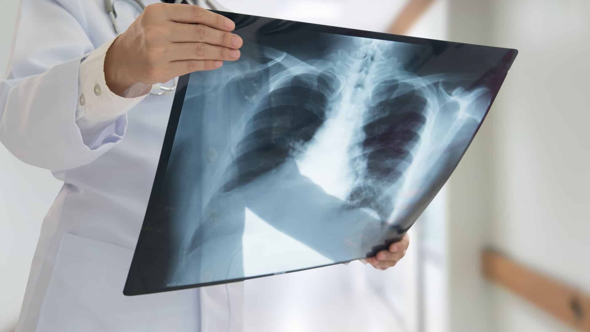 Les pneumologues avertissent de l'importance du dépistage dans la détection précoce du cancer.