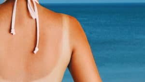 Va à la plage Voici les zones les plus vulnérables aux coups de soleil (et comment les prévenir)
