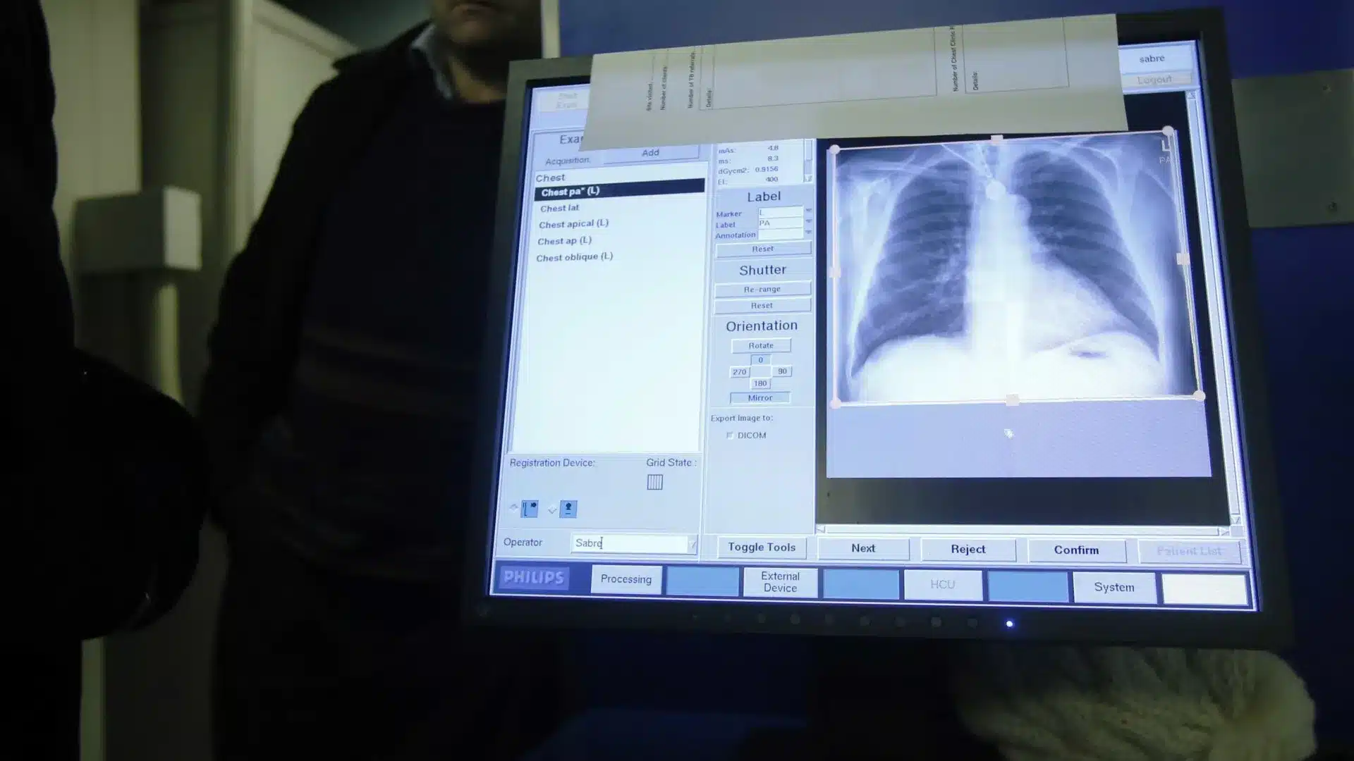 Cas de tuberculose pulmonaire détecté dans un hôtel de la région de Lisbonne