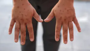 Un nouveau foyer de variole du singe identifié à Lisbonne.