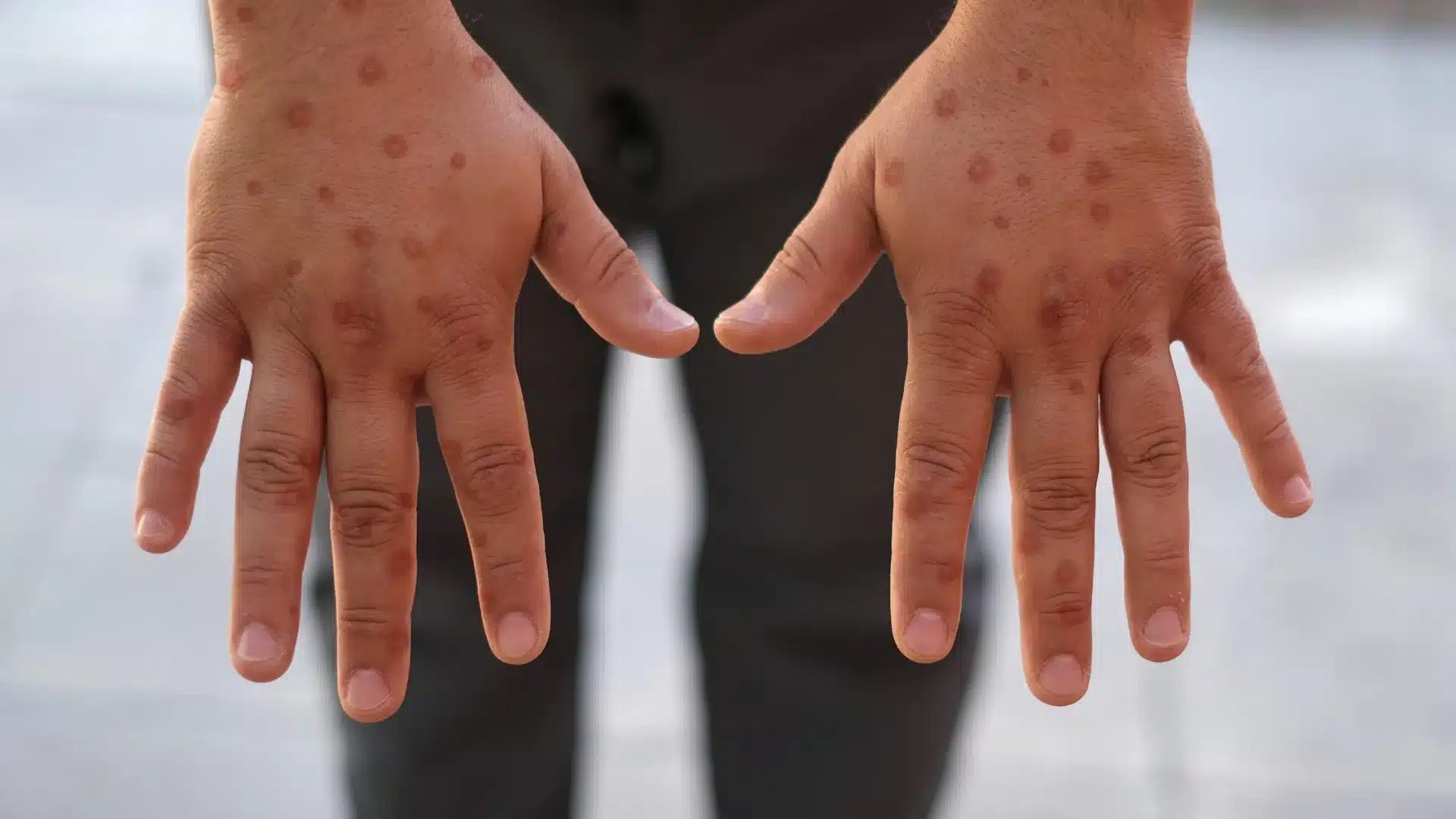 Un nouveau foyer de variole du singe identifié à Lisbonne.