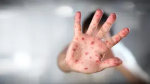 La DGS a enregistré "20 cas de rougeole" depuis le début de l'année au Portugal.