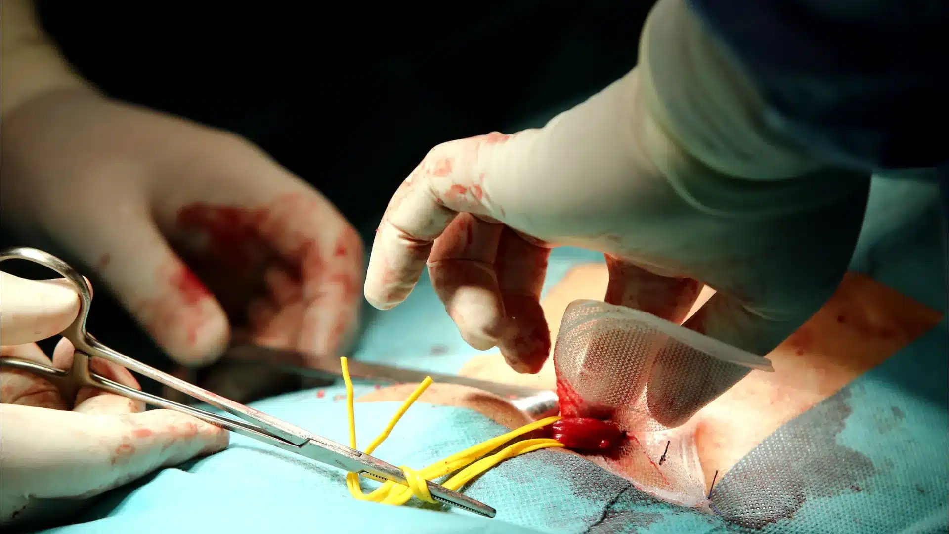 Le temps d'attente pour les chirurgies les plus graves double.