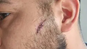 Lisbonne. Des jeunes agressent un réfugié irakien avec "une pierre, une bouteille" et des coups de poing.