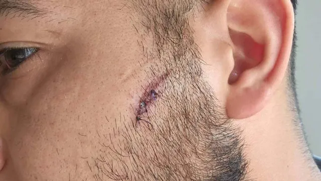 Lisbonne. Des jeunes agressent un réfugié irakien avec "une pierre, une bouteille" et des coups de poing.