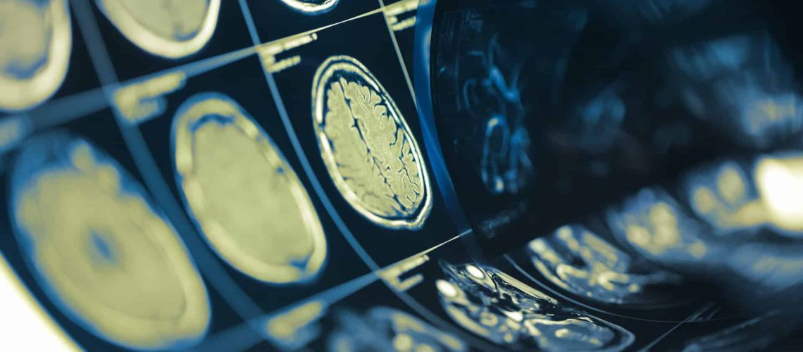 Journée du Cerveau. Les facteurs de risque (et signaux d'alerte) à connaître