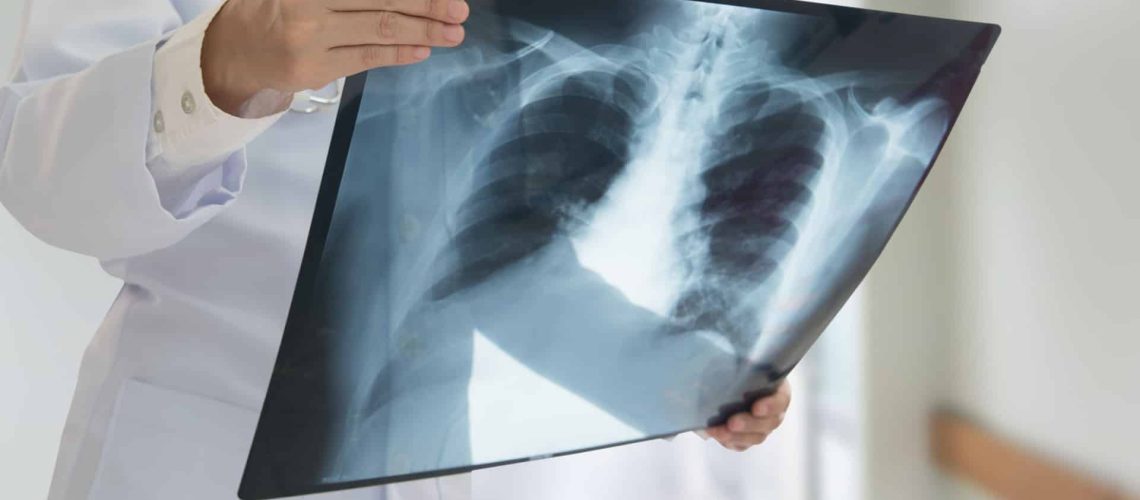 Les pneumologues avertissent de l'importance du dépistage dans la détection précoce du cancer.
